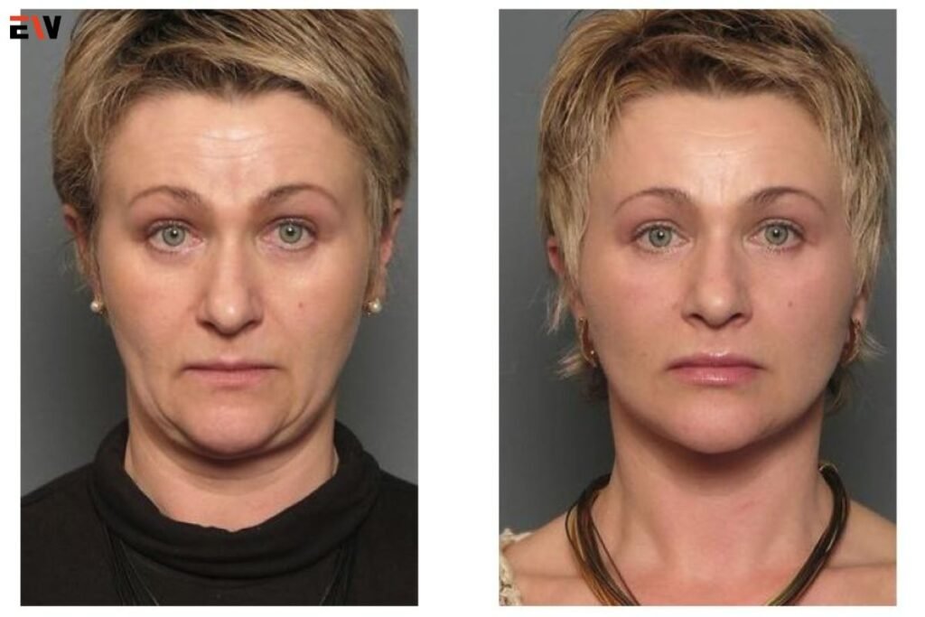 Understanding the Factors Influencing Face Lift Costs